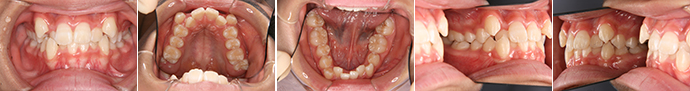 第Ⅱ期治療前