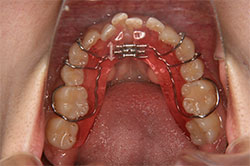 アライナー以外の矯正装置（拡大床装置）
